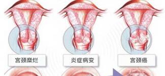 被宫颈糜烂困扰的女性，这次终于可以放心了！
